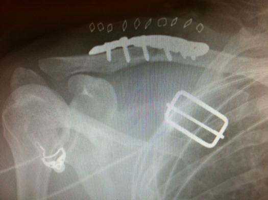 Plate XRay
